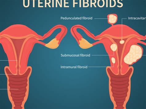 Best Uterine Fibroids Treatment In Chennai Uterine Fibroids Hospital