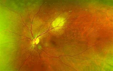 Ophthalmic Oncology Signssymptoms Diagnosis Treatment Nuhs