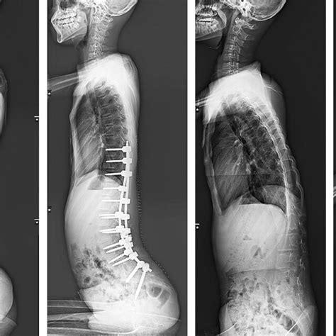 Whole Spine Radiograph Of A Patient With No Difficulty In Postoperative Download Scientific