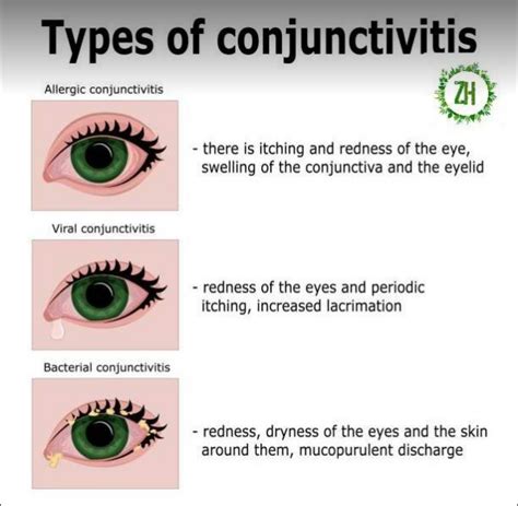 Pink Eye in Kids: Causes, Symptoms, and Effective Management ...