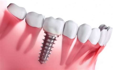 Prix de la pose d implant dentaire en Tunisie combien ça coute