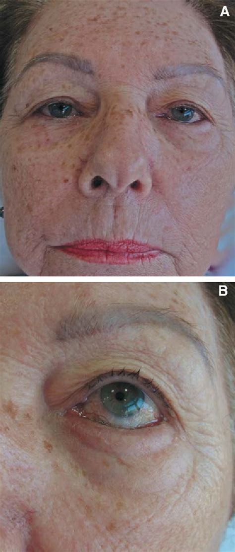 Figure From New Techniques Blepharoplasty With Correction Of Senile