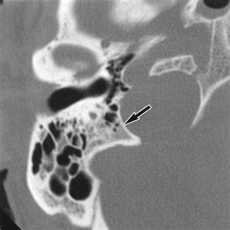 Primary Jugular Foramen Meningioma Imaging Appearance And