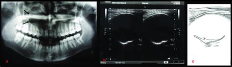 A Case Of Radicular Cyst Shows Simple Cystic Appearance A Panoramic