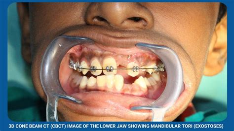 Exposure Of Unerupted Teeth Balaji Dental And Craniofacial Hospital