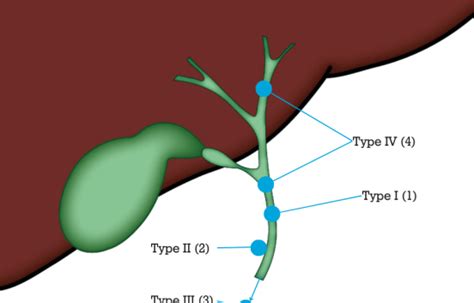 Choledochal Cysts British Liver Trust