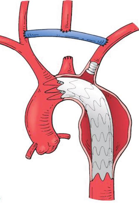 Debranching Zone 1 Type 3 Using Bypass With Graft Note Closure Of The Download Scientific