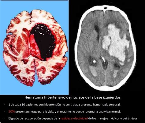 Qu Tratamos Cirug A Neurol Gica Mx