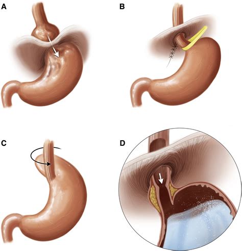 Ten Things Every Gastroenterologist Should Know About Antireflux