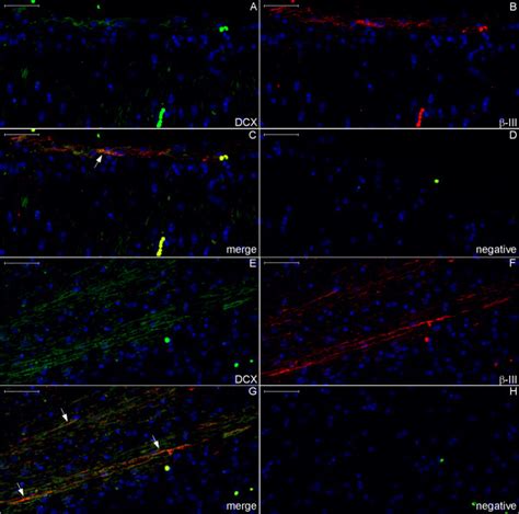 Dcx And Iii Tubulin Expression In The Body Of The Fornix And Corpus