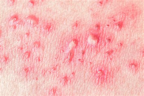 Mild Shingles Symptoms