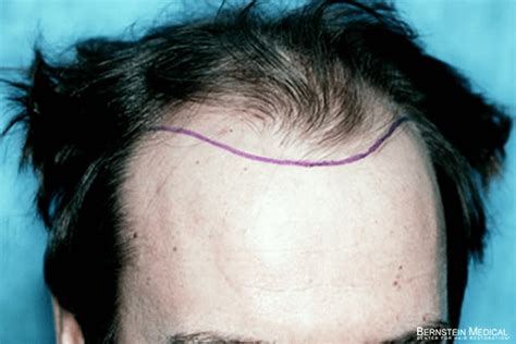 Patient Ahb Bernstein Medical Center For Hair Restoration