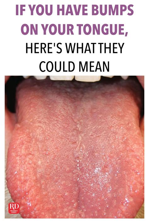 Big Bumps On Back Of Tongue Eaclear