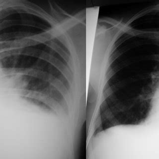 Resolution of pleural effusions after treatment for loiasis. Chest ...