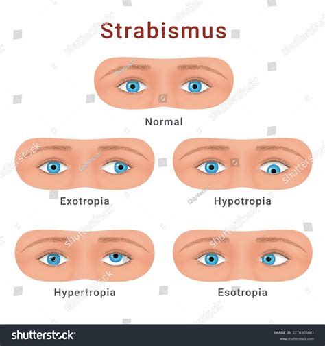 Vektor Stok Strabismus Eyes Types Normal Hypotropia Hypertropia (Tanpa ...