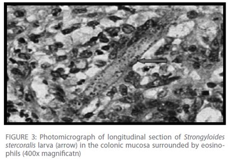 Strongyloides Colitis Presented With Acute Abdomen