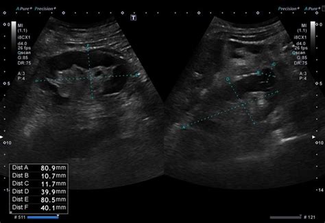 Portal Vein Thrombosis Ultrasound