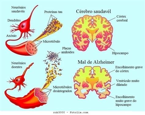 Mal De Alzheimer Sintomas E Causas Doença Demencia Idade Jovens