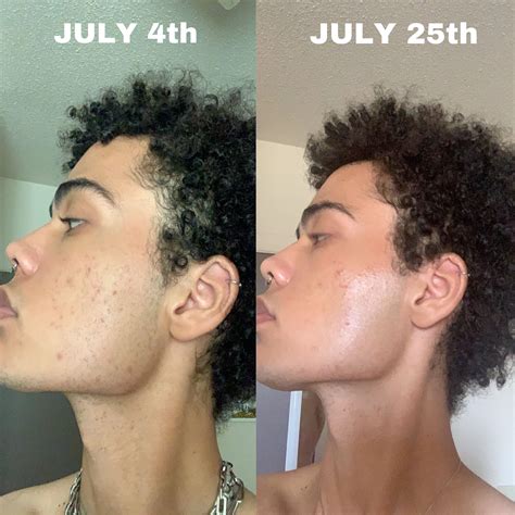 3 Weeks Progress From When I Began Using Tret Feeling Better About My Skin Already Tretinoin