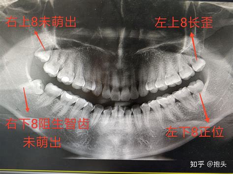 看牙记：记录一下在杭州拔牙补牙和洗牙的经历，杭口和省口~杭州想看牙的小伙伴们可以参考一下 知乎