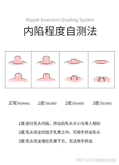 自测一下，您是否存在乳头内陷？ 知乎