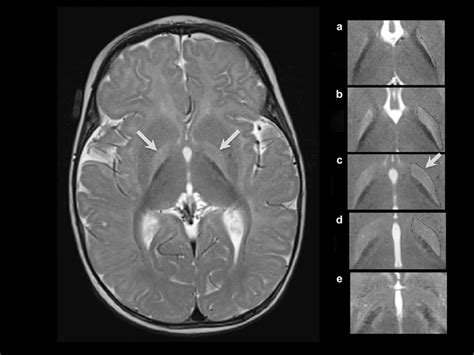 T2 Weighted Axial Mri At 6 Months Of Age In A Male Born At 40 Weeks Of