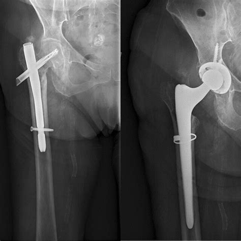 A Preoperative radiograph demonstrating nonunion of an extracapsular ...