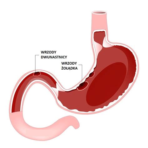 Wrzody O Dka Czy Dwunastnicy Jak Je Rozr Ni Porady W Interia Pl