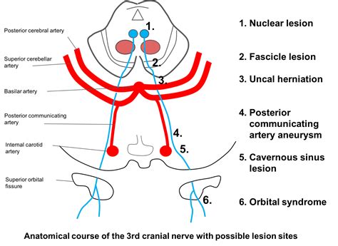 Third Nerve Palsy Case Based Neuro Ophthalmology