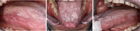 Oral Lichen Planus Opmdcare