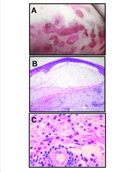 Clinical And Histologic Characteristics Of Bullous Pemphigoid A Download Scientific