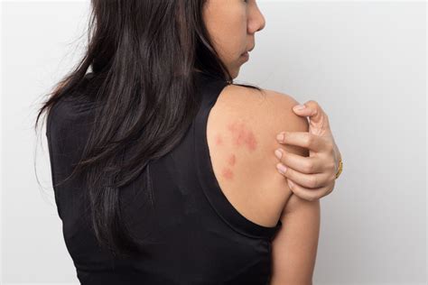 Chronic Urticaria Symptoms Causes And Treatment