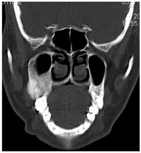 Fibrous Dysplasia Of Maxilla