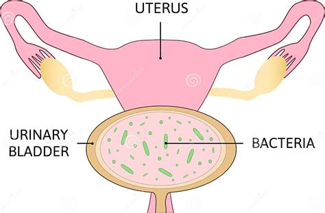 Uterine Polyps Human Realistic Uterus Anatomy Illustration Stock