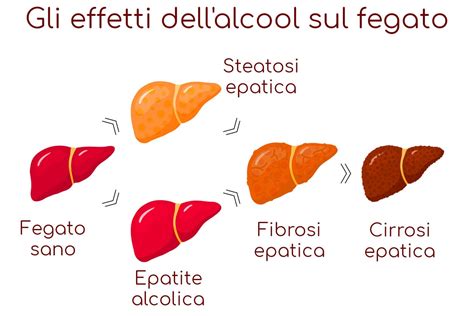 Trattamento Della Cirrosi Epatica Alcolica