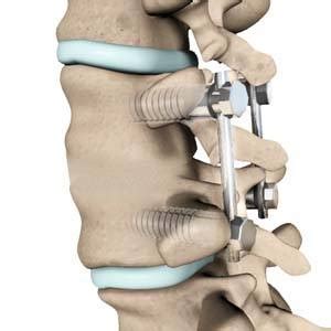 Laminectomy With Fusion