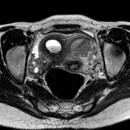 Unicornuate Uterus With Hematometra In Non Communicating Contralateral