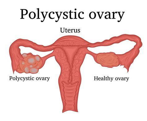 The Story of Polly Who Had Polycystic Ovaries (Part 1)