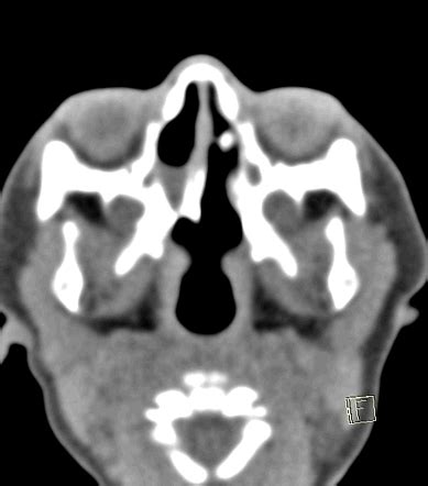 Unilateral choanal atresia | Radiology Case | Radiopaedia.org