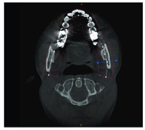 A Showing Mandibular Axial Section Showing Cross Sectional Cbct Image