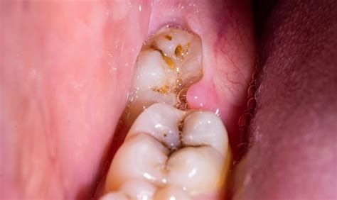 Dry Socket 5 Days After Wisdom Teeth Extraction