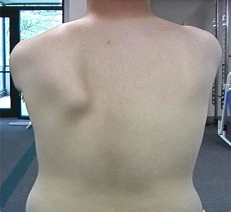 Example Of Scapular Dyskinesis Showing Medial Border And Inferior Angle