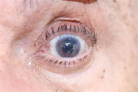 Before And After Corneal Transplant