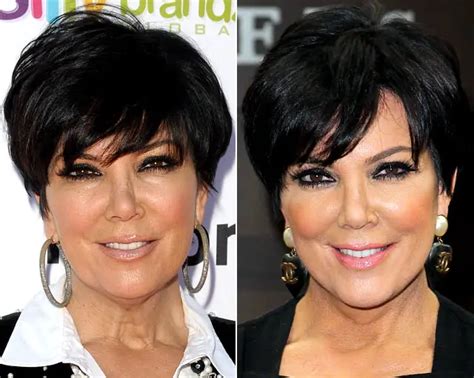 Kris Jenner Nose Job Plastic Surgery Before and After | Celebie
