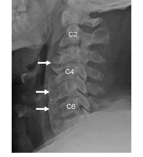 Degenerative Cervical Disc