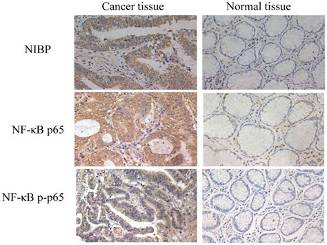 Nik And Ikk Binding Protein Contributes To Gastric Cancer