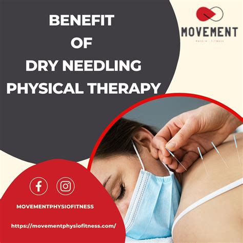 Benefit Of Dry Needling Physical Therapy The Benefit O Flickr