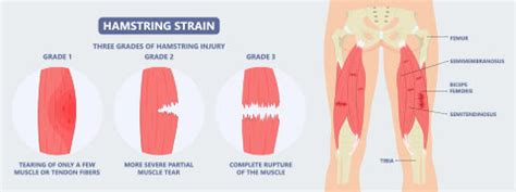 Hamstring Injury: Causes, Symptoms And Treatment