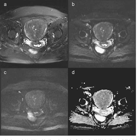 Figure 1 From The Utility Of Diffusion Weighted Mr Imaging In