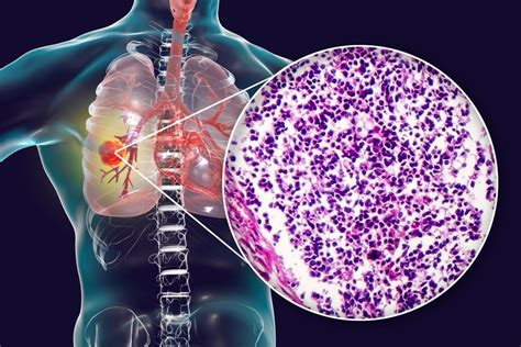 Microcitoma Polmonare Sintomi Diagnosi E Terapie